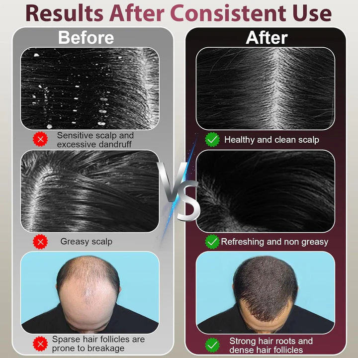 Laser Therapy Hair Growth Comb